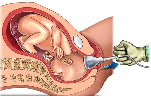 Hút thai có ảnh hưởng gì tới sức khỏe thai phụ không?